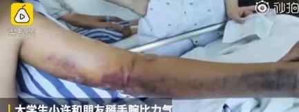 掰手腕致手臂粉碎性骨折 这是真的吗你还敢掰手腕吗