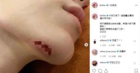 范玮琪下巴缝15针是什么情况?范玮琪怎么了?