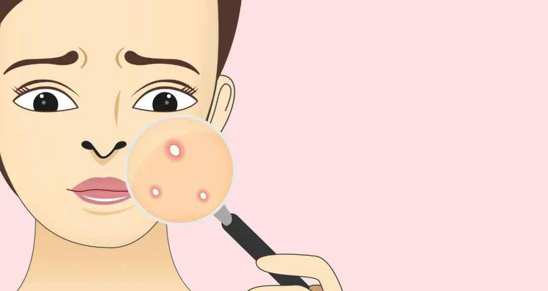 如何去痘印痘疤 如何去痘印？文章配图