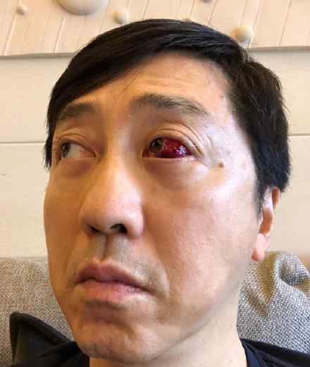 庾澄庆眼睛受伤 庾澄庆是谁什么情况
