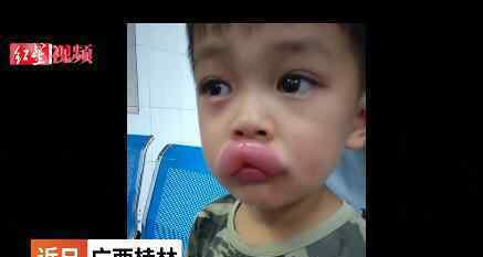 男孩吃葡萄过敏肿成嘟嘟嘴 对此大家怎么看？