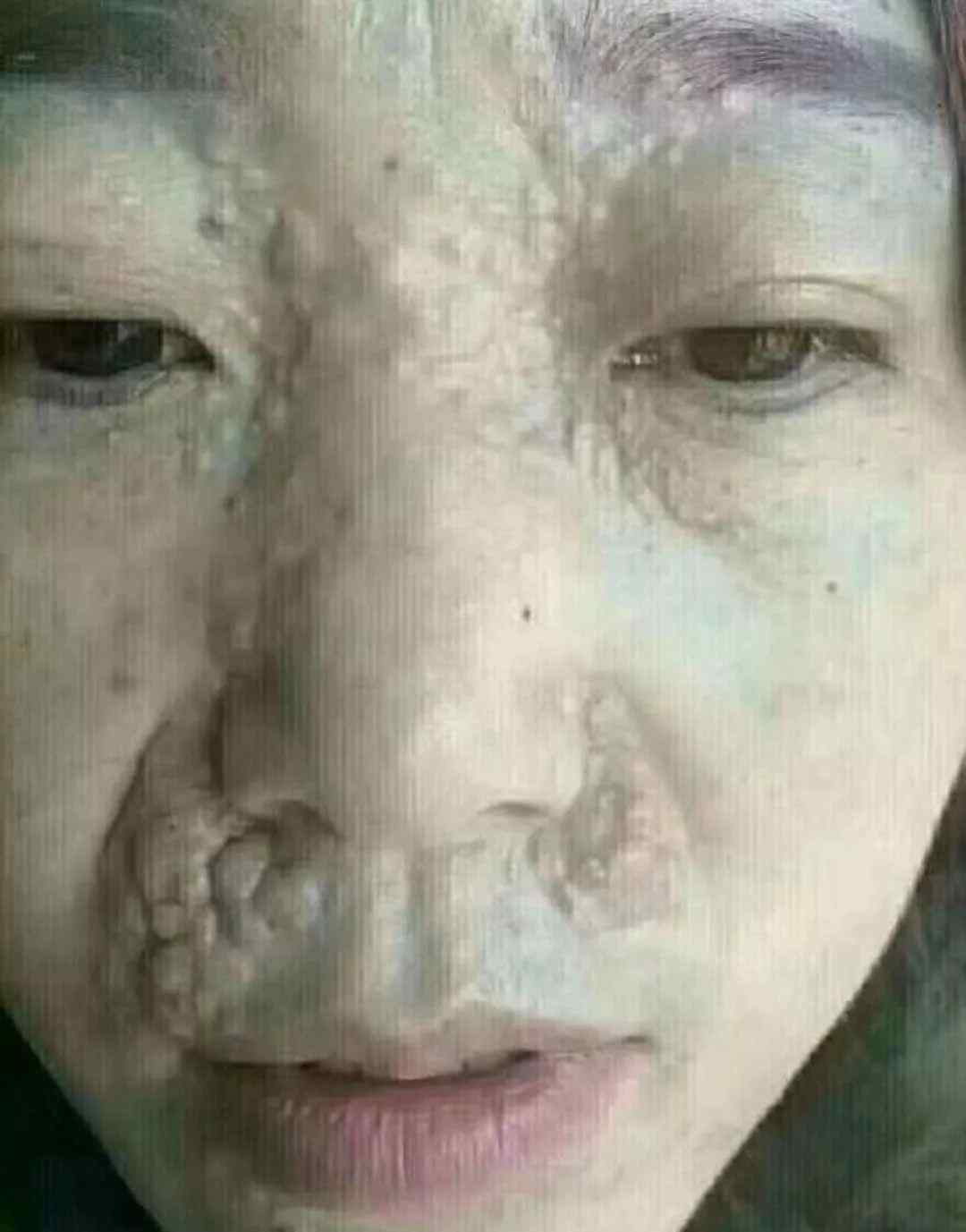 表皮内上皮瘤 毛发上皮瘤到底是怎么回事?