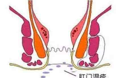肛门湿疹的症状 肛门湿疹，你不可忽视的危害！