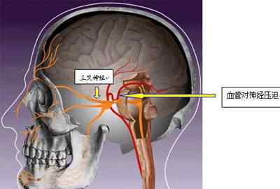 神经痛该怎么办 【诊前须知】出现三叉神经痛疼痛时该怎么办？