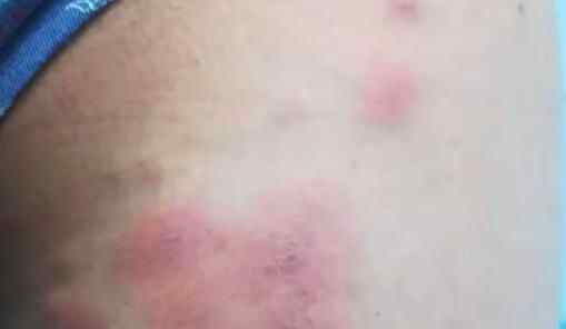 高一男生臀部起大片红疹还超痒 医生开出的处方亮了究竟是怎么回事？