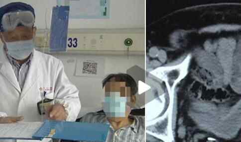 7旬大爷腹部疼痛难忍来求医 医生一看CT吓了一跳究竟是怎么回事？