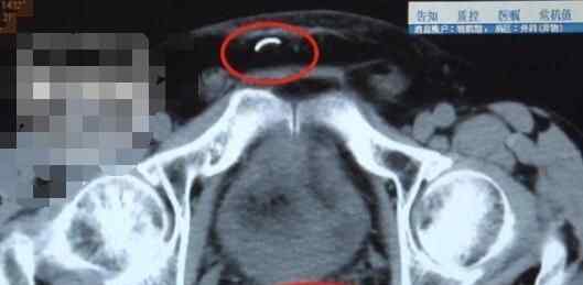 7旬大爷腹部疼痛难忍来求医 医生一看CT吓了一跳究竟是怎么回事？