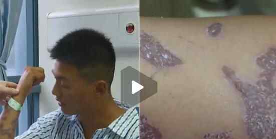 吓坏!男子游泳遭袭击伸手去挡 上岸后身体出现可怕变化