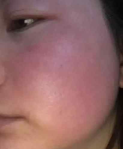 脸部浮肿是疾病的前兆吗?