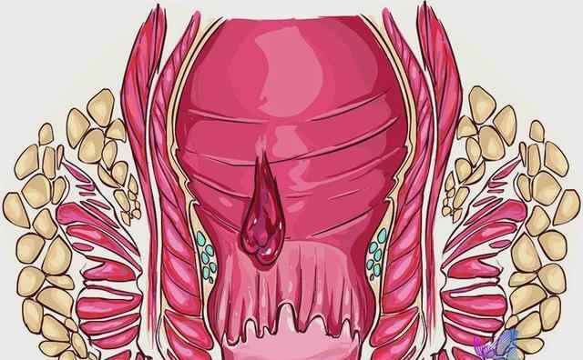 十女十痔是真的吗 不敢相信！"十人九痔"竟与这一习惯有关！很多人每天都做却毫不知情