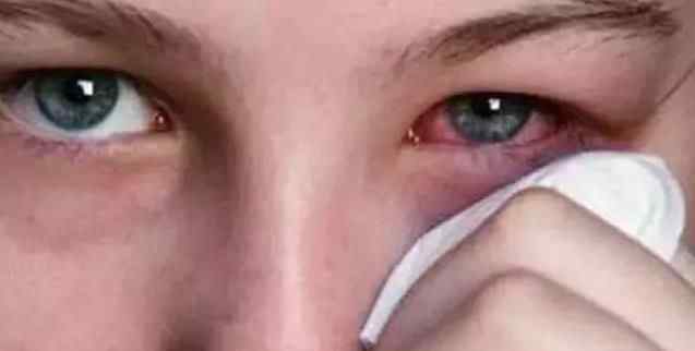 男子眼睛痒,睫毛里竟爬出3条虫 简直吓尿了