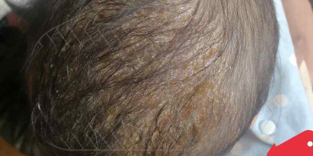 婴儿头上有黄水结痂图 宝宝头皮流黄水、结痂是怎么回事？不是湿疹而是...