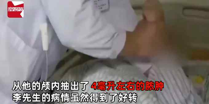 快放下挤痘痘的手！男子挤痘引发颅内脓肿 致上肢瘫痪