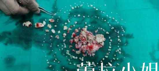 一少年患罕见牙瘤 口内移除232颗增生牙齿