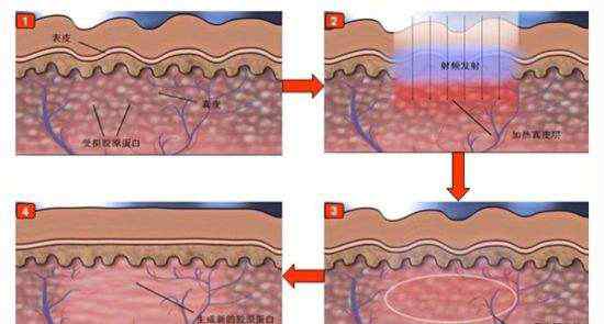 激光祛斑安全吗 激光祛斑安全吗，会不会对皮肤造成伤害