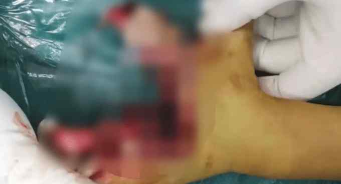 长沙8岁男童捡烟花燃放手被炸烂，骨头外露，画面令人心痛