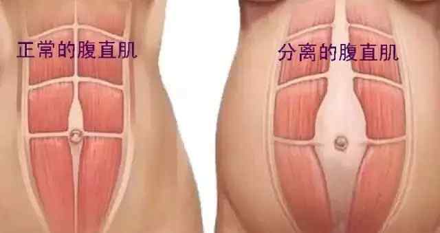 腹直肌分离锻炼方法图 正确认识产后腹直肌分离及产后恢复锻炼方法