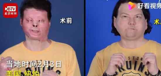 全球首例成功换脸换手手术 具体效果如何