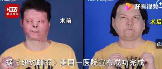 全球首例成功换脸换手手术 现在变成什么样了
