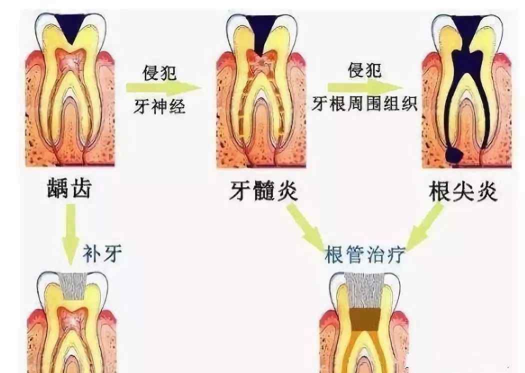 蛀牙最严重图片 一张图读懂蛀牙不补的后果有多严重！