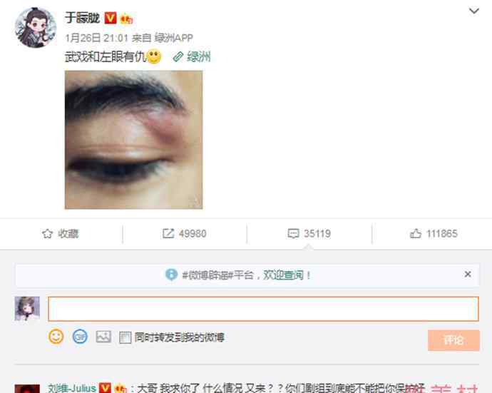 于朦胧拍戏左眼又受伤 粉丝喊话要保护好自己