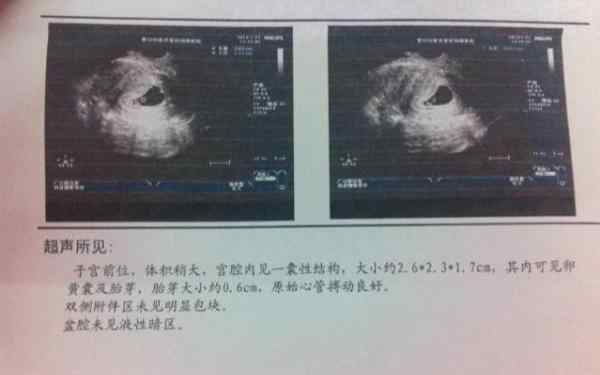 卵黄囊什么意思 卵黄囊回声是什么意思？