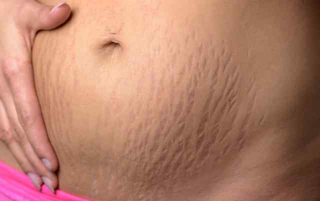 孩子妊娠纹 为何有人生完孩子妊娠纹不明显？宝妈说了实话，孕期偷偷这样做