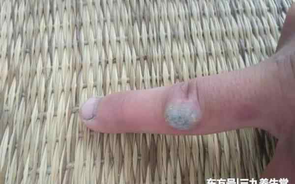 寻常疣是什么 什么是寻常疣？它和HPV病毒有什么关系？这3种方法，或能帮你
