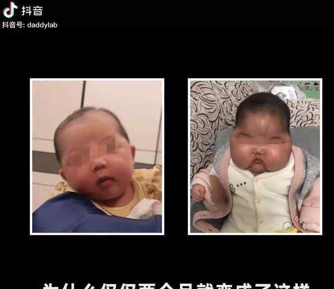 揭婴儿变大头娃原因