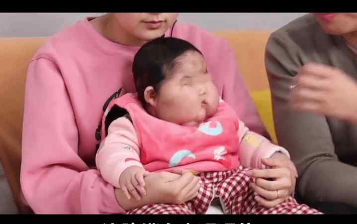 揭婴儿变大头娃原因