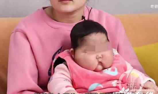 5月大婴儿用抑菌霜后成大头娃娃 还原事发经过及背后真相！