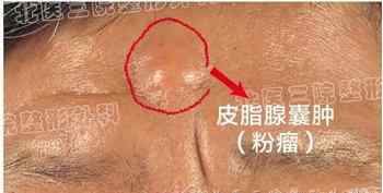 表皮样囊肿 表皮样囊肿是怎么回事，严重吗？