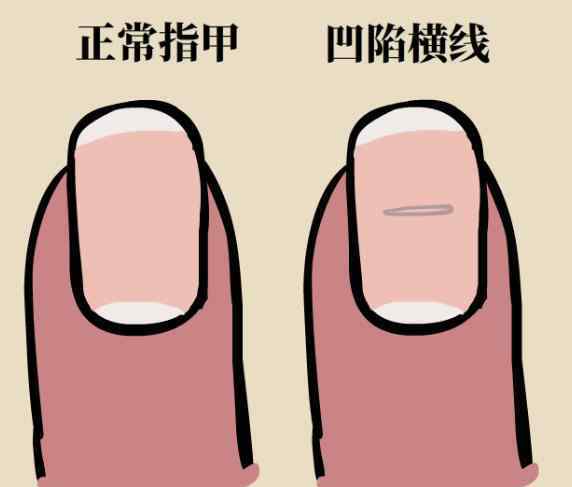 匙状甲 指甲出现了凹痕，我到底是怎么了