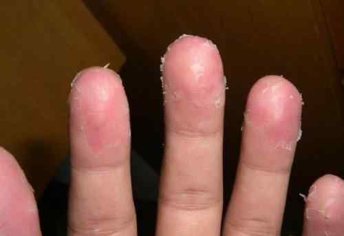 儿童手脱皮用什么药膏 孩子的手老是脱皮，妈妈千万别大意，医生：可能和这3种病有关系