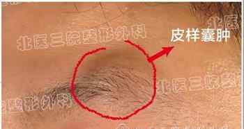 表皮样囊肿 表皮样囊肿是怎么回事，严重吗？