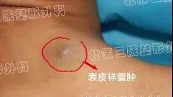 表皮样囊肿 表皮样囊肿是怎么回事，严重吗？