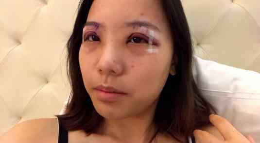 女商人抽脂成植物人10年后死亡 抽脂有什么风险和后遗症
