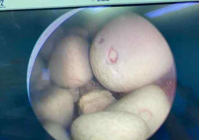 男子晨起无法排便 到医院一查惊呆：体内竟有“一窝鸟蛋”