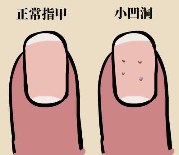 匙状甲 指甲出现了凹痕，我到底是怎么了
