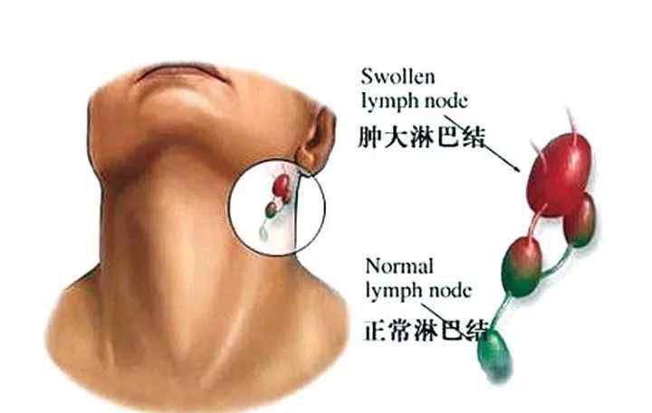 肿大淋巴结是什么意思 【医生说】体检发现淋巴结肿大，到底是几个意思？
