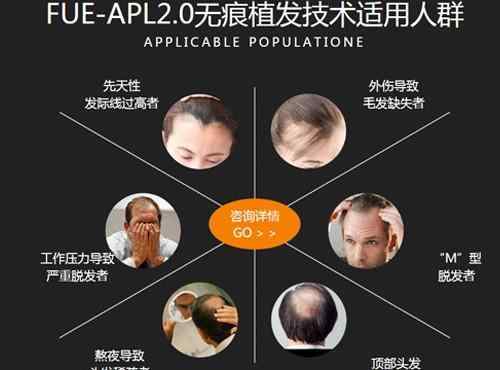 植发去哪个医院 去植发选择什么医院？4点让你明白！