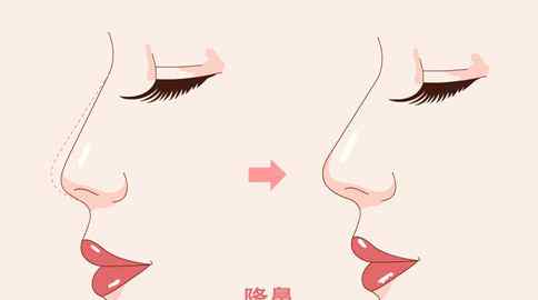 鼻子做个假体要 有没有人做了鼻子后悔的，千万不要去隆鼻整后悔