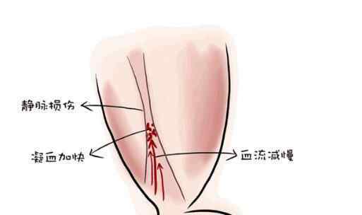 女孩崴脚后身亡 到底是怎么死的？
