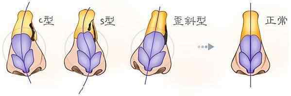 鼻尖整形修复 鼻整形失败？！现在告诉你什么时候可以修复！