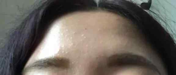 封闭性粉刺是什么 封闭性痘痘是什么？