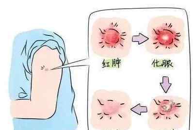 卡介苗接种成功的标志 宝宝接种卡介苗后，有这些情况得赶紧送医院