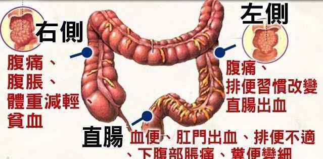 长期大便不成形 大便不成形一定是肠癌吗？别慌，医生告诉你怎么办！