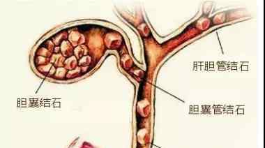 胆囊结石手术费 胆囊结石手术费是多少？看了这个你就知道！