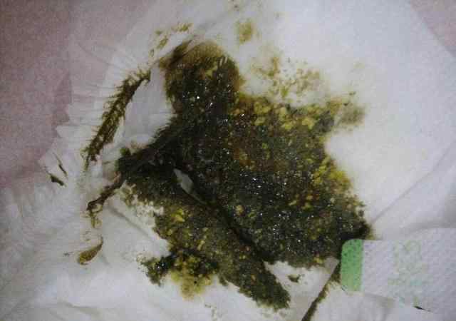 奶瓣屎图片 一图详解宝宝便便隐藏的健康问题，看完再也不用去群里发屎图了