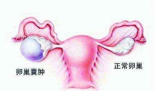 卵巢囊肿会自己消失吗 生理性卵巢囊肿会自己消失，怎么判断是生理囊肿？